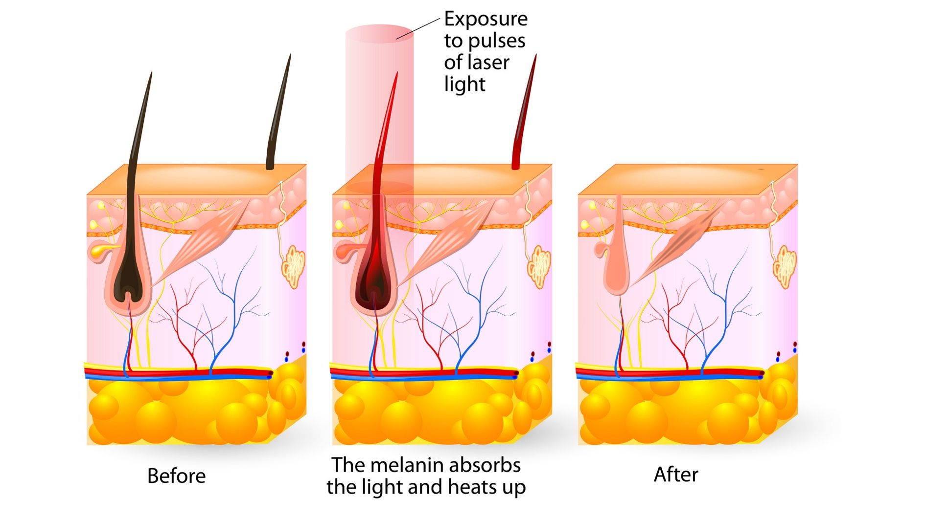 laser destroying hair follicle and 5-14 days to fall out