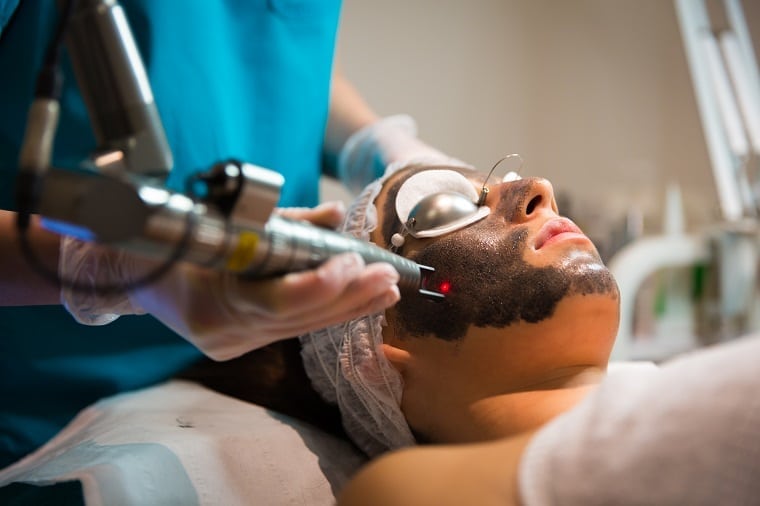 Carbon Facial