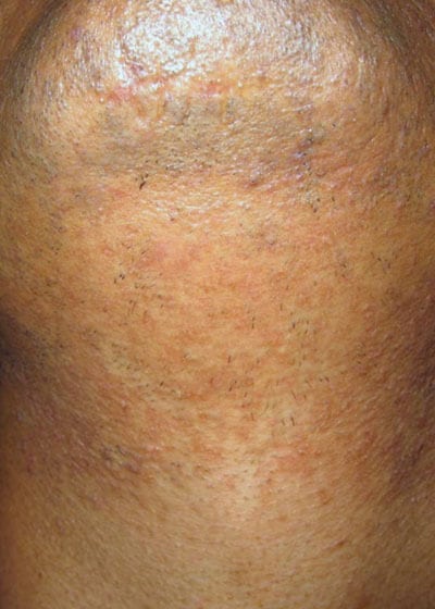 laser hair removal beard after