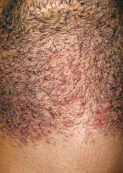 laser hair removal bear before