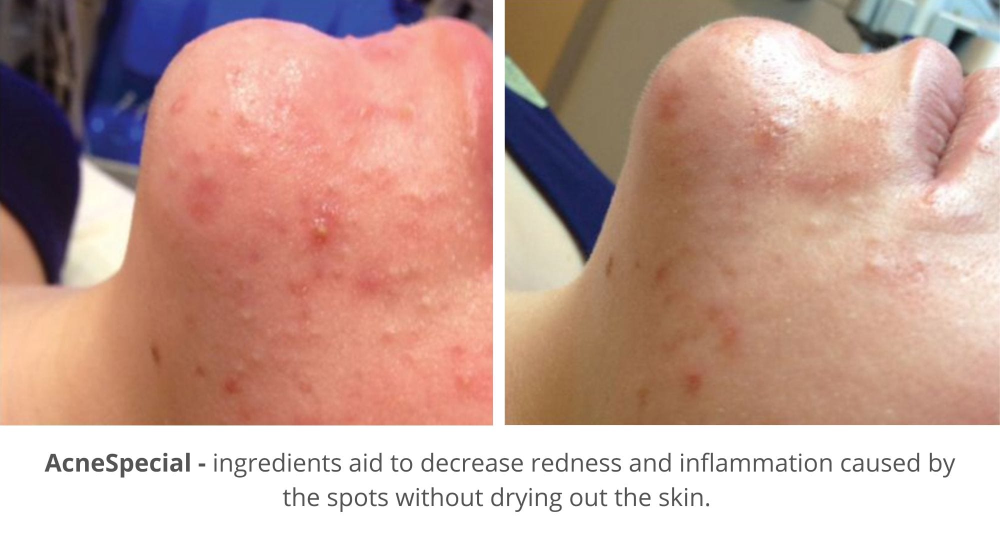 hydrafacial before and after photo for acne