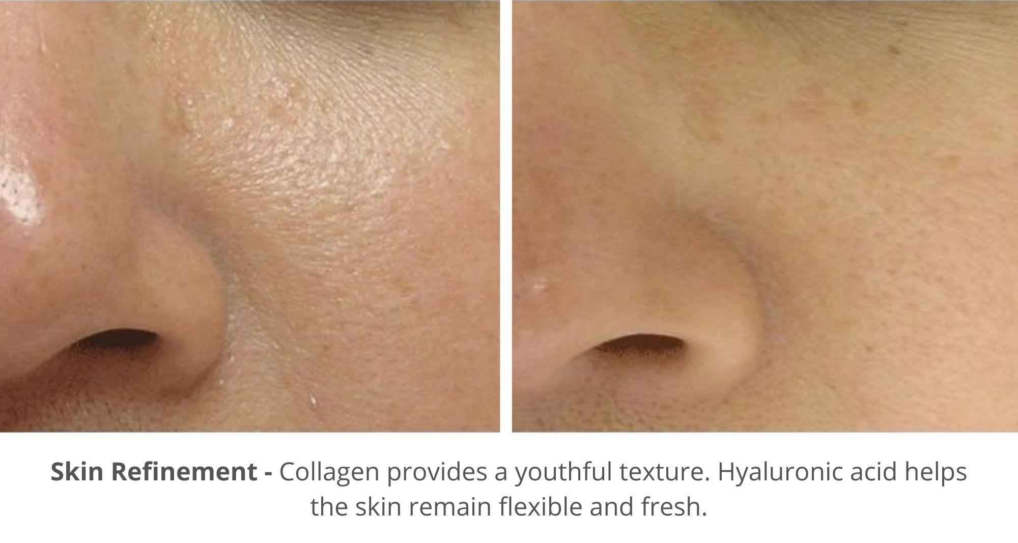 hydrafacial before and after photo effect on skin