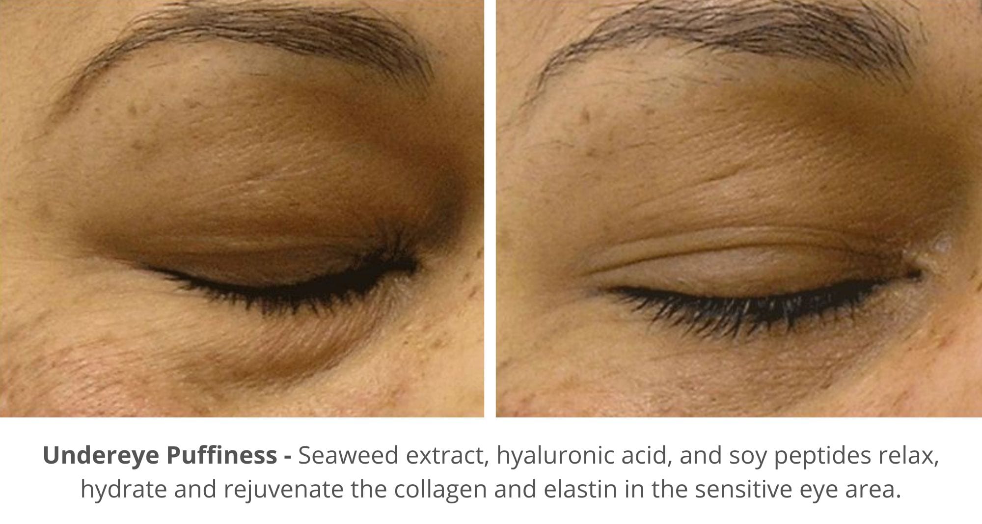hydrafacial before and after photo for eye puffiness