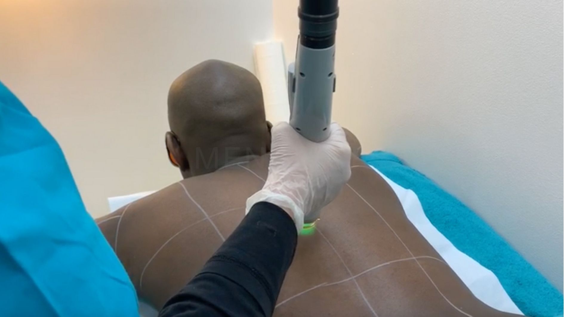 laser hair removal for men