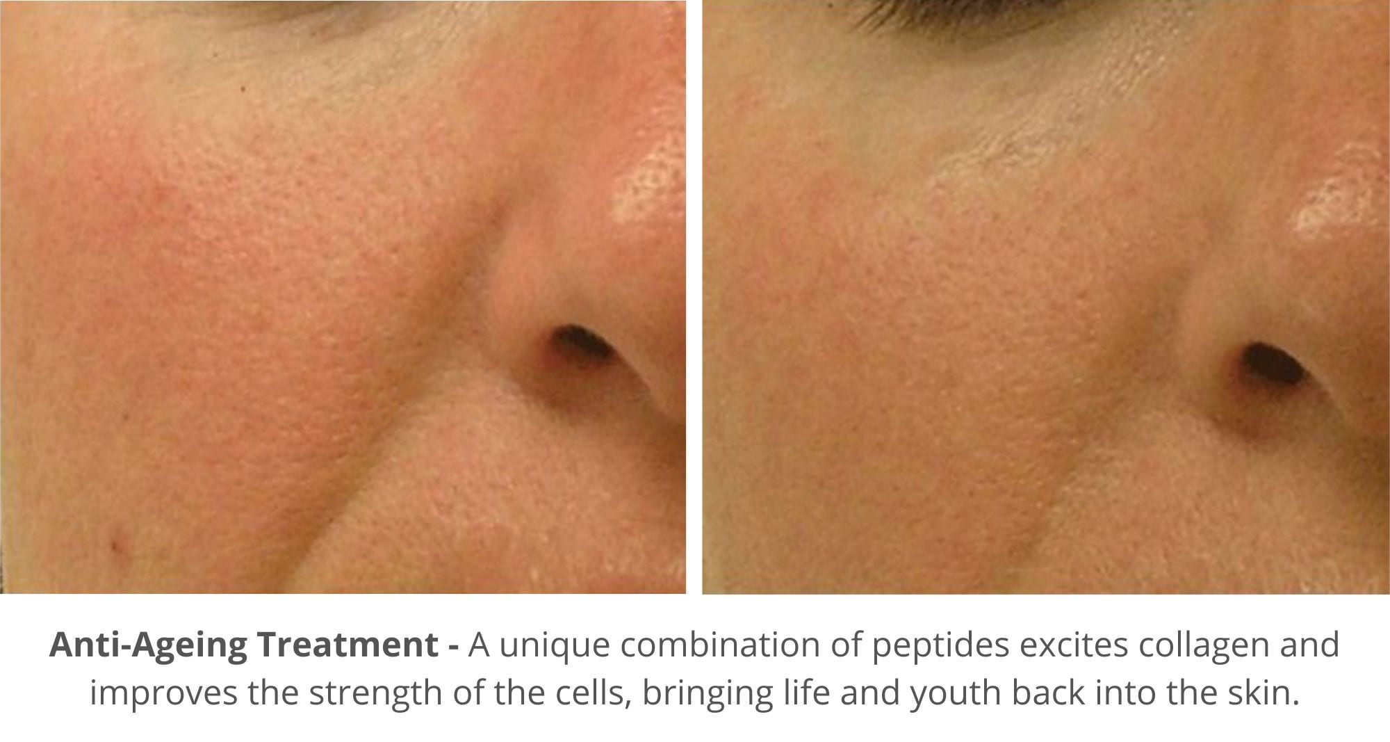 hydrafacial before and after photo for collagen stimulation and fine lines