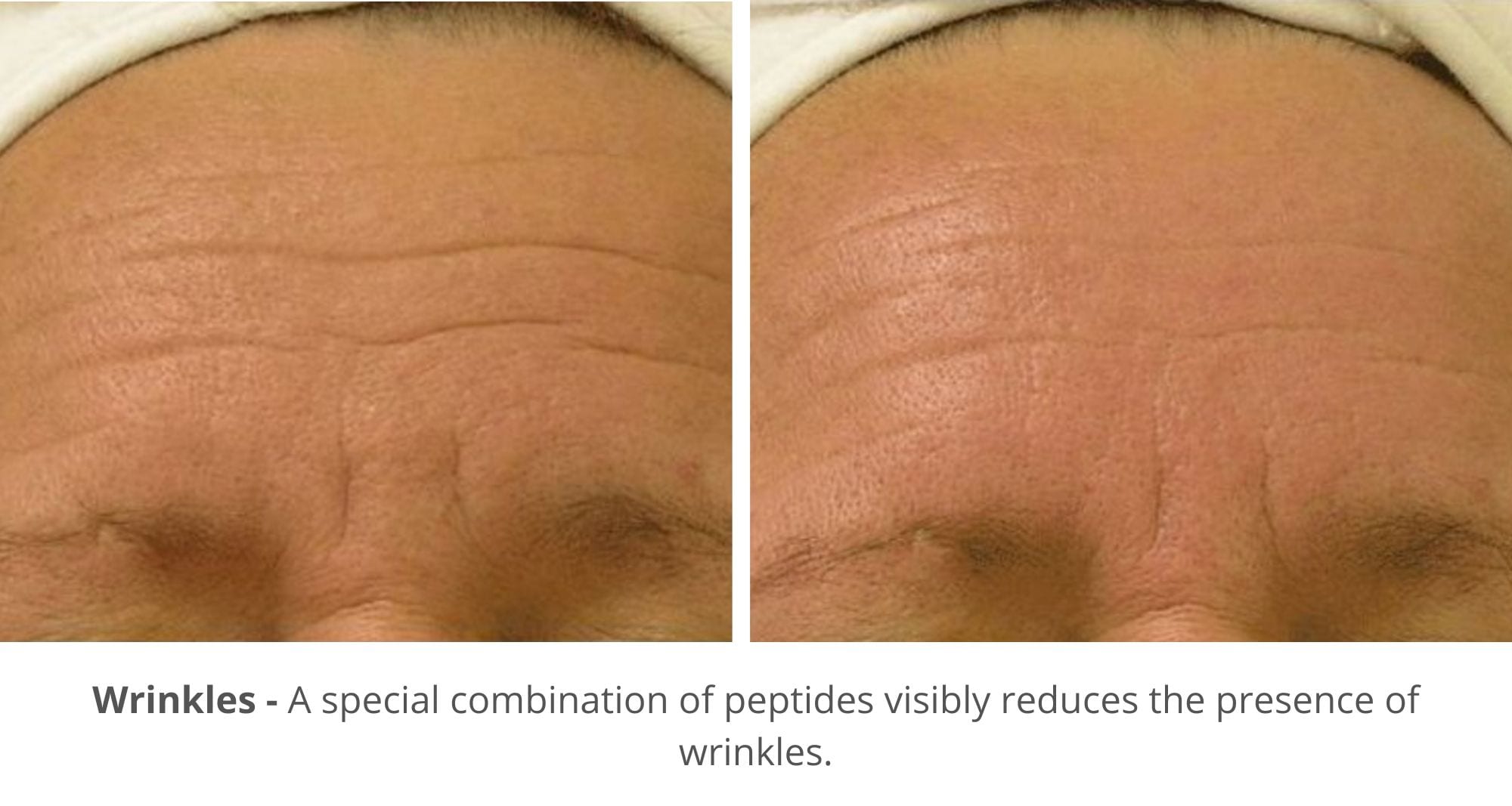 hydrafacial for before and after photo for wrinkles