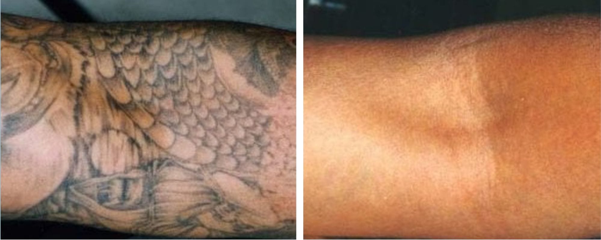 laser tattoo removal