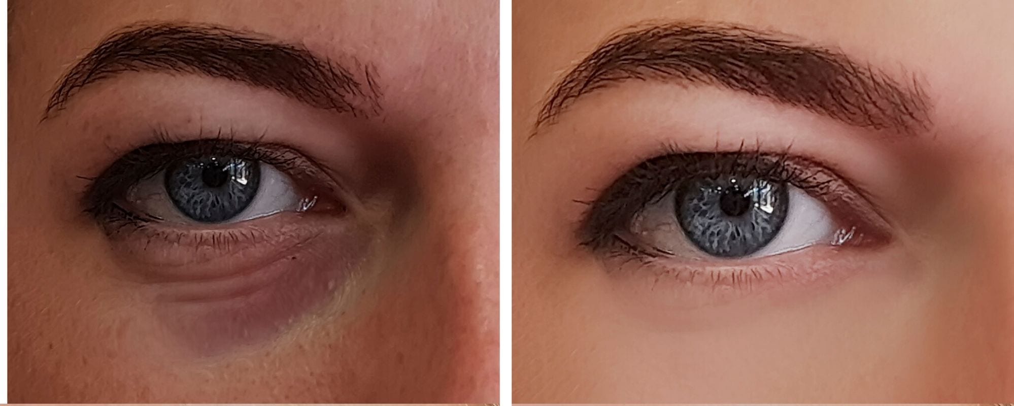 eye bag before and after
