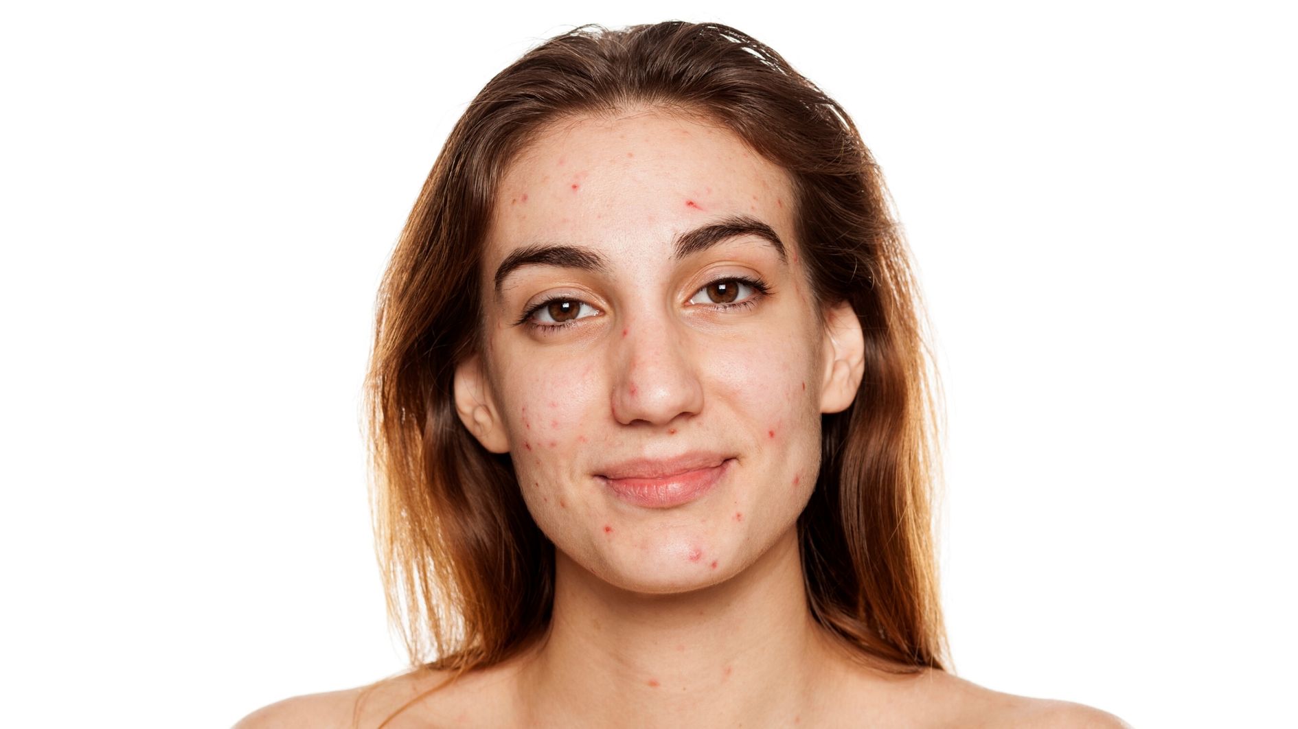 acne model