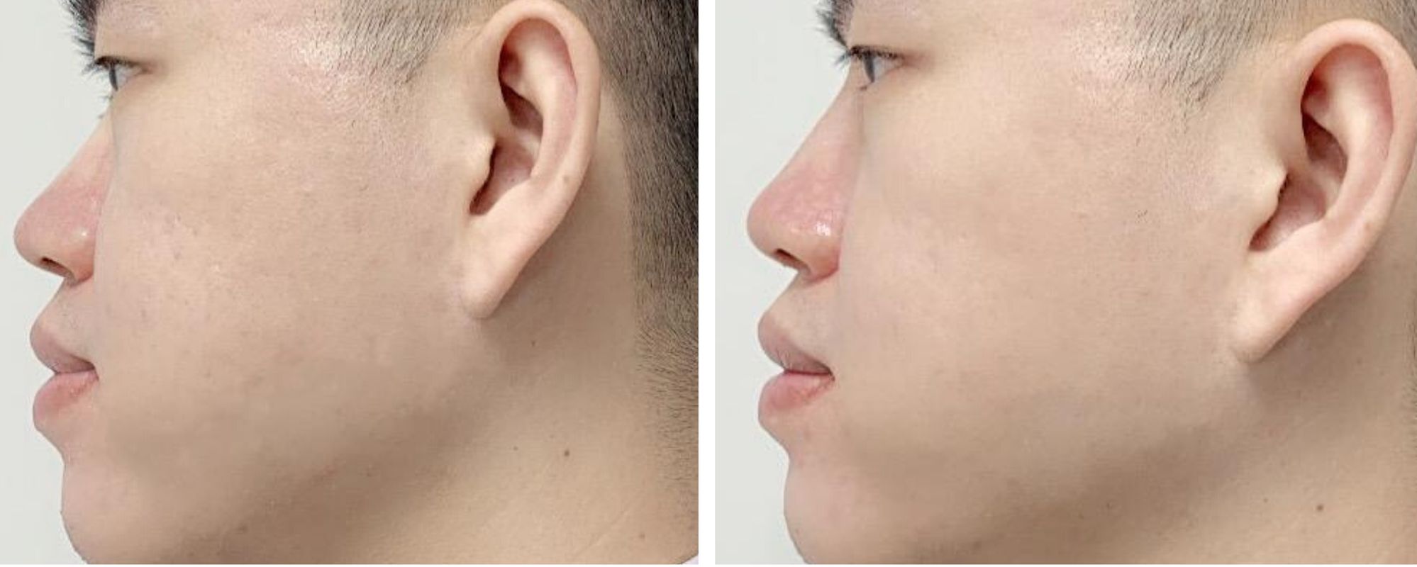 microneedling before and after