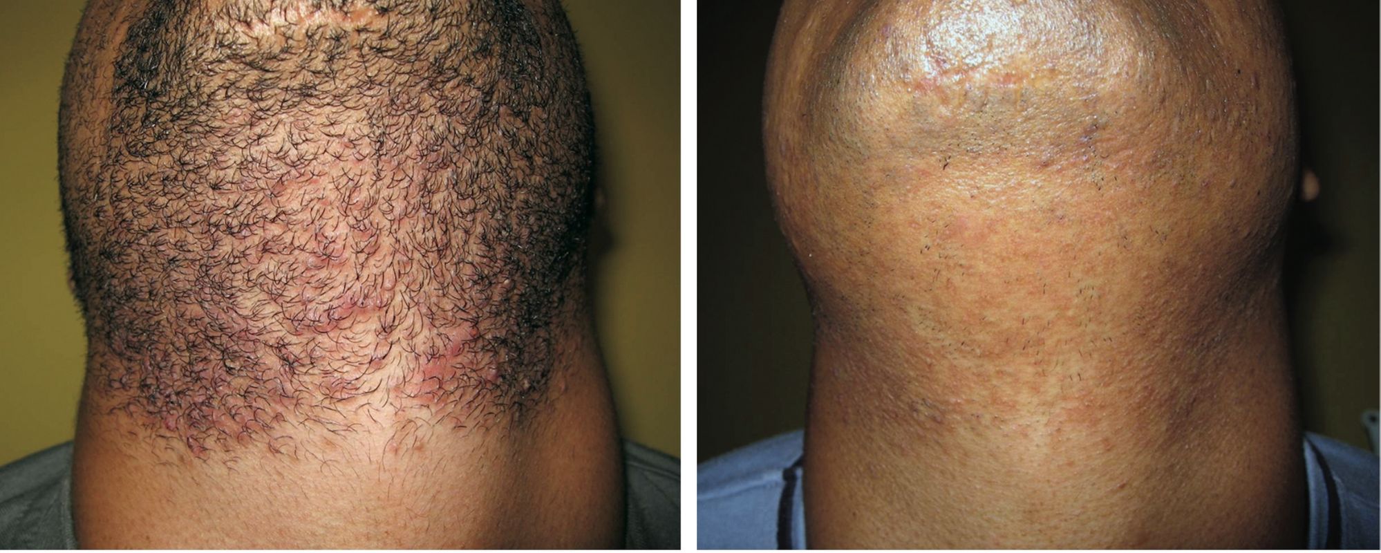 laser for men on chin pic