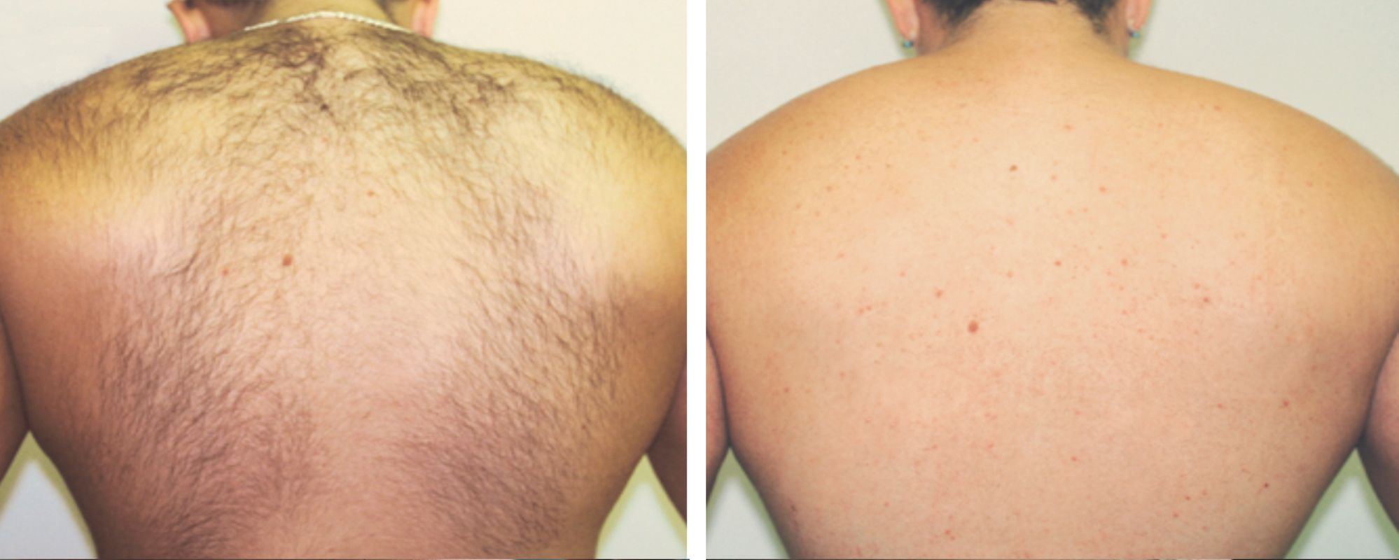 men back laser hair removal
