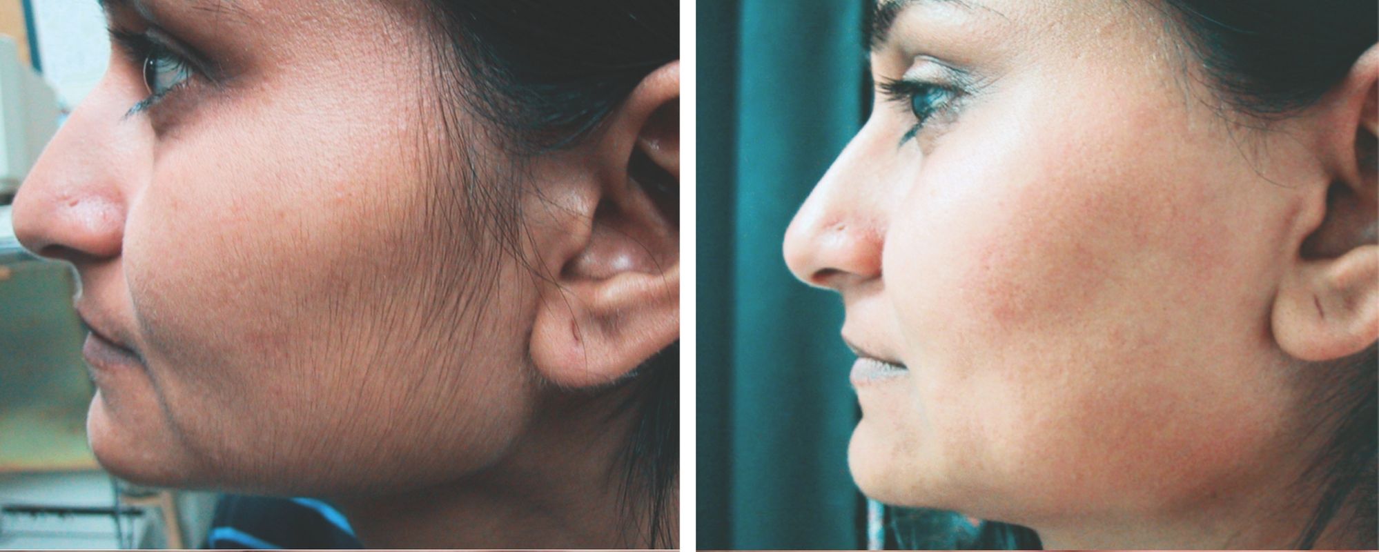 before and after facial laser hair removal treatment pictures