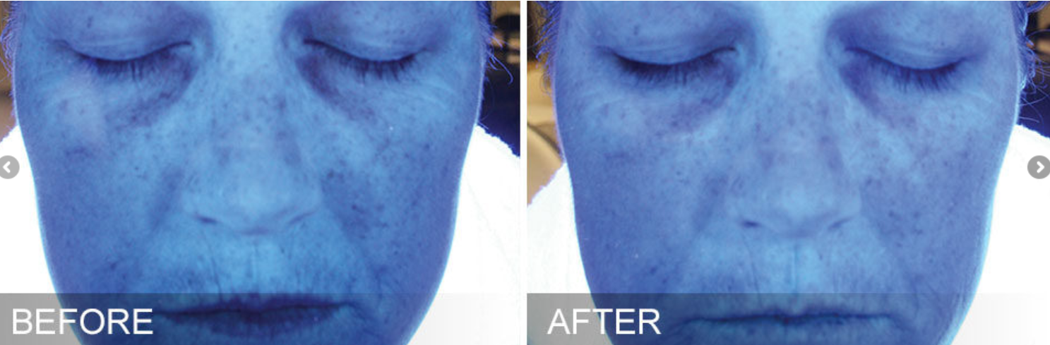 before and after hydrfacial skin analysis photo