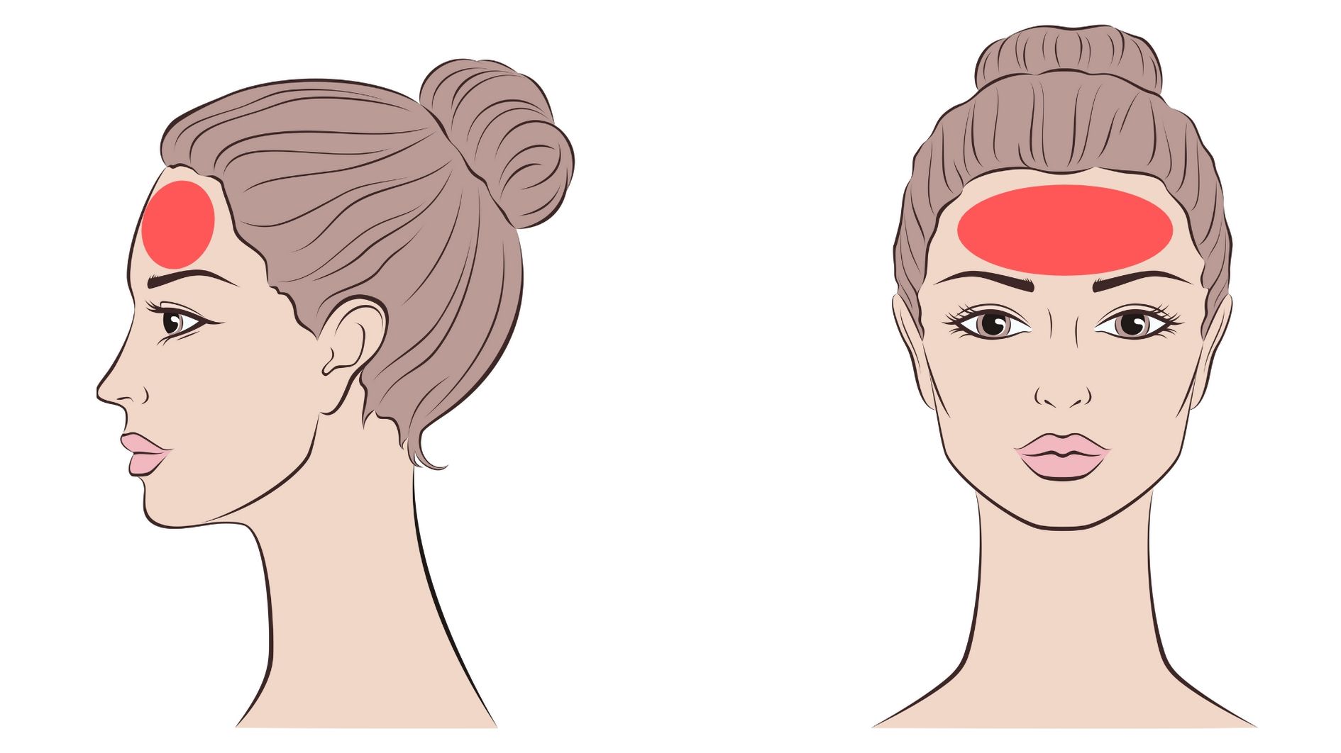 facial laser hair removal forehead and hairline treatment area