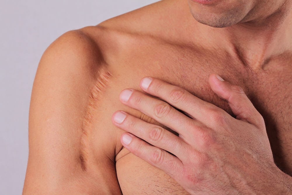 Best Treatments for Scarring