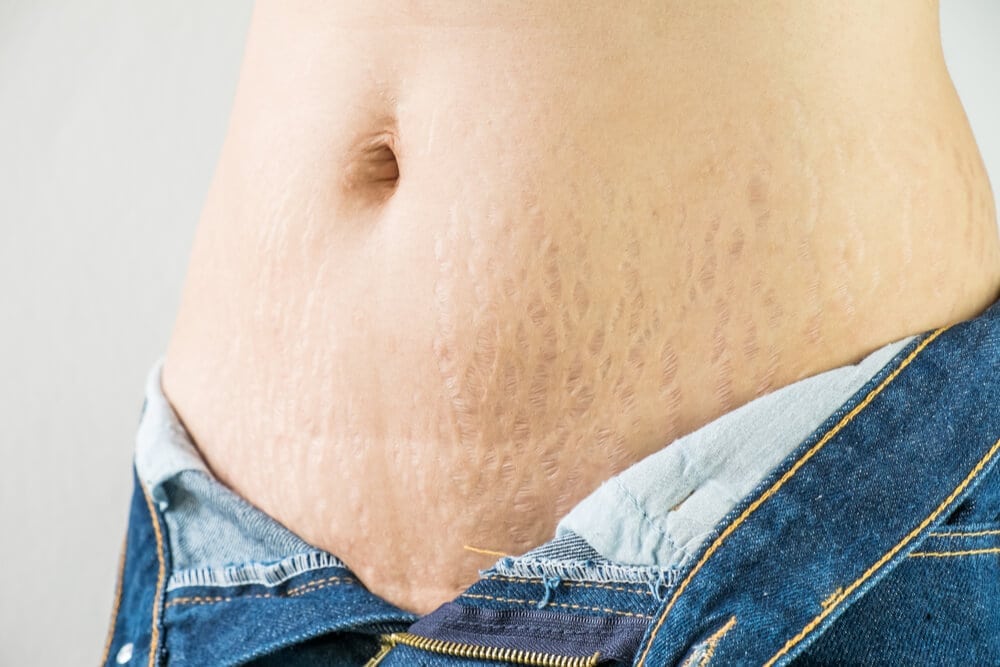 Stretch Marks And Pregnancy