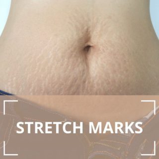 stretch marks on stomach