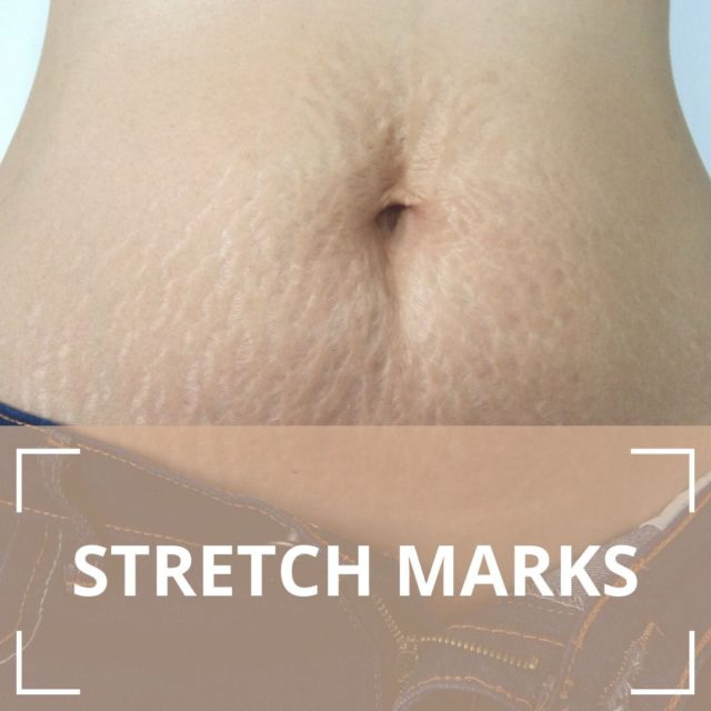 stretch marks on stomach