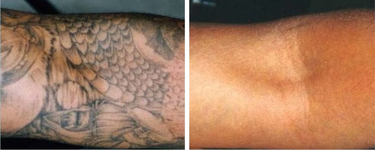 Tattoo Removal: Can It Be Used On All Tattoos?