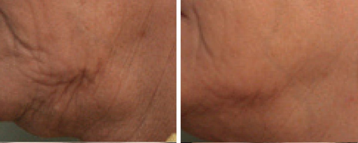 Is The Face Slimmer Exercise Mouthpiece The Answer To Your Wrinkles?
