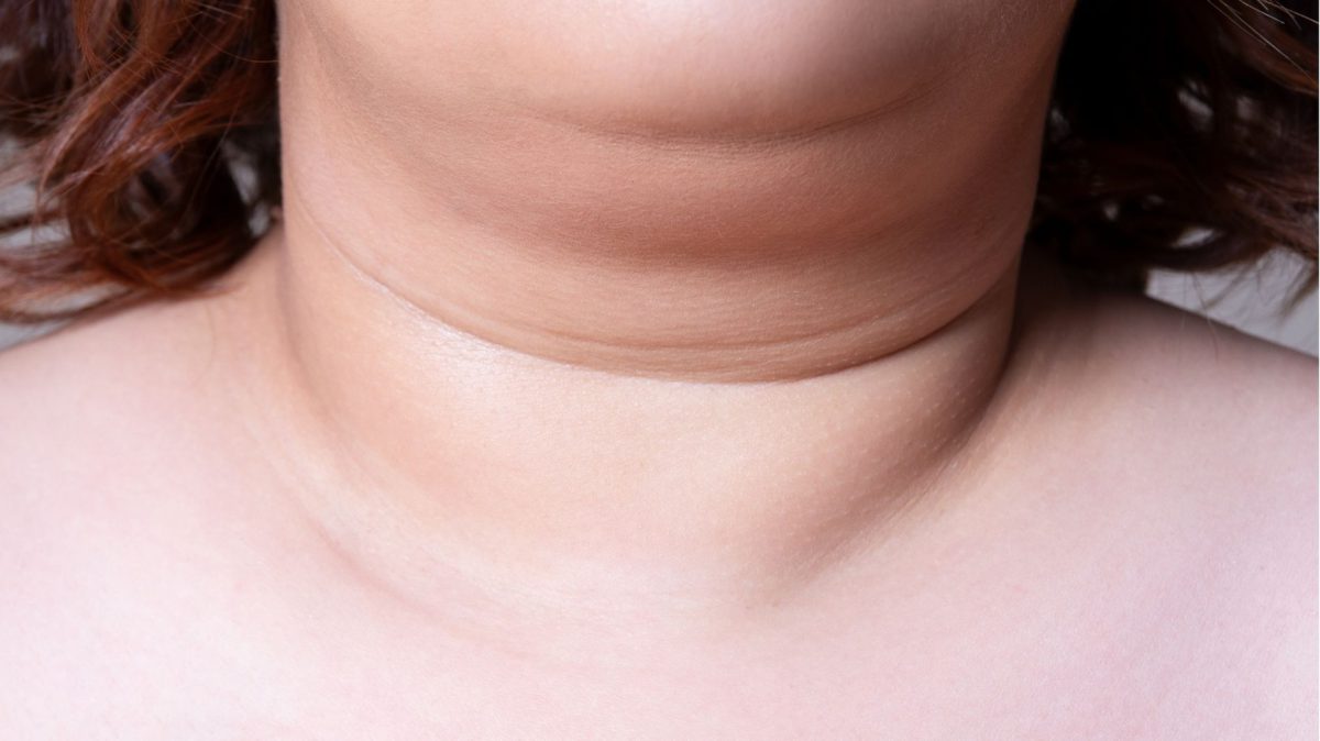 Coolsculpting for double chin