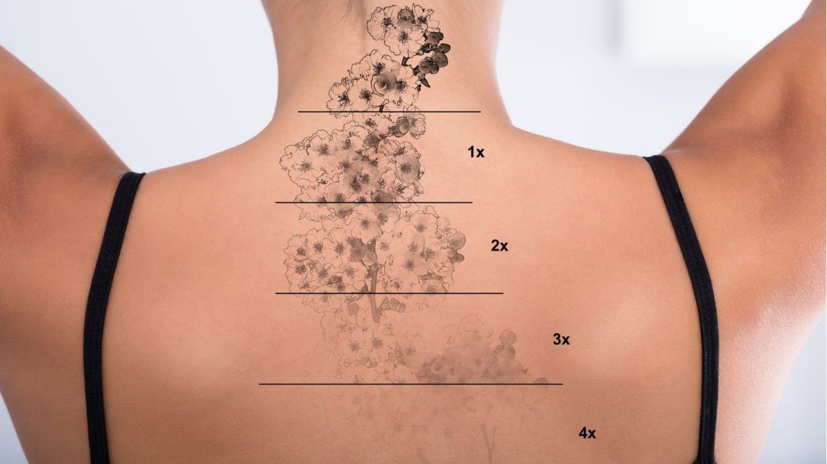 Tattoo removal with Lumenis Stellar M22 laser