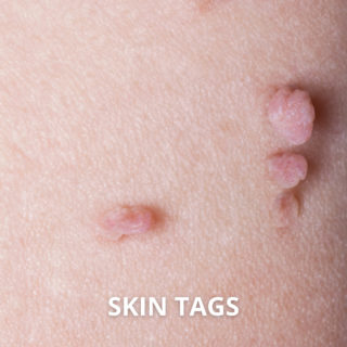 SKIN TAGs